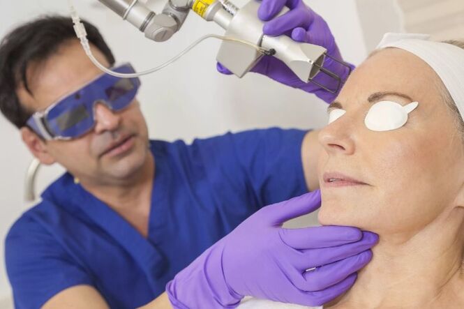 Renewal of skin with a laser