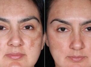 Before and after the renewal procedure