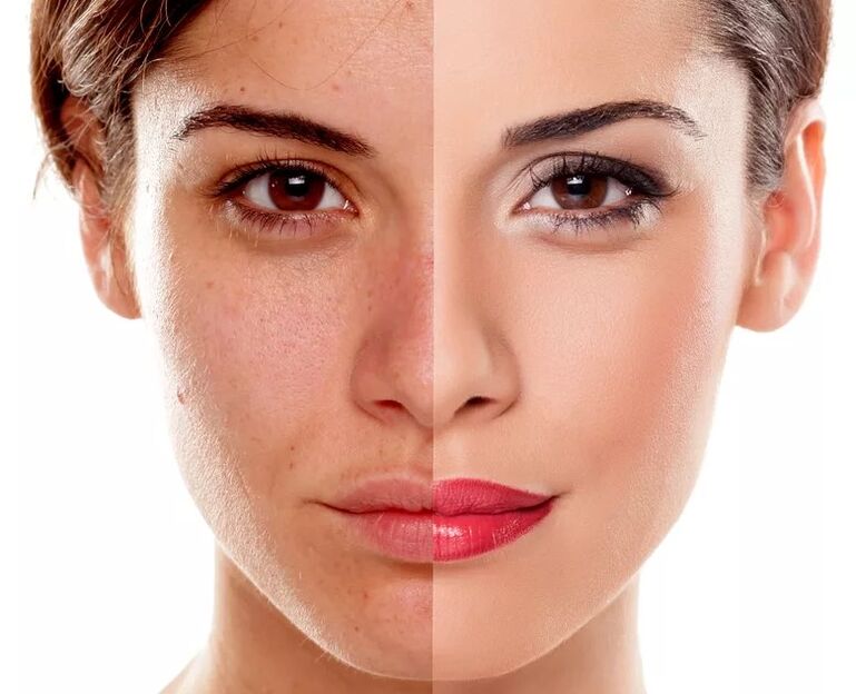 Flat tone of skin
